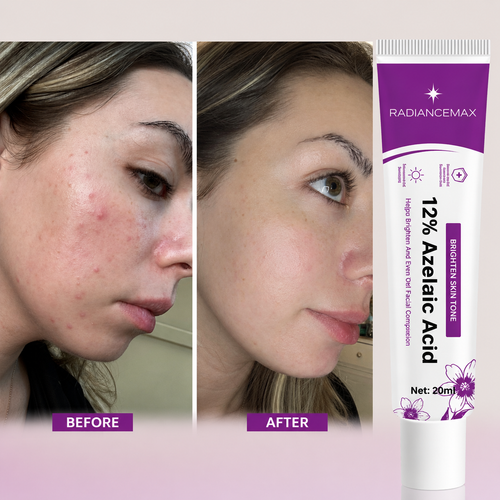RadianceMax - Acne Recovery Cream